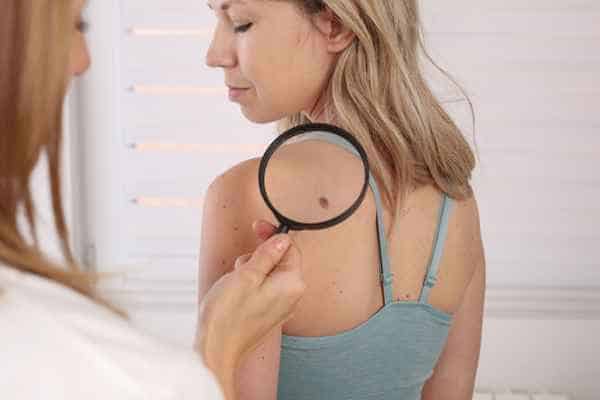 What Are Traditional Skin Lesion Removal Methods Bletchley?