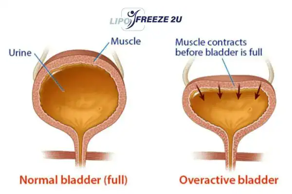 diagram of overactive bladder treatment Bletchley