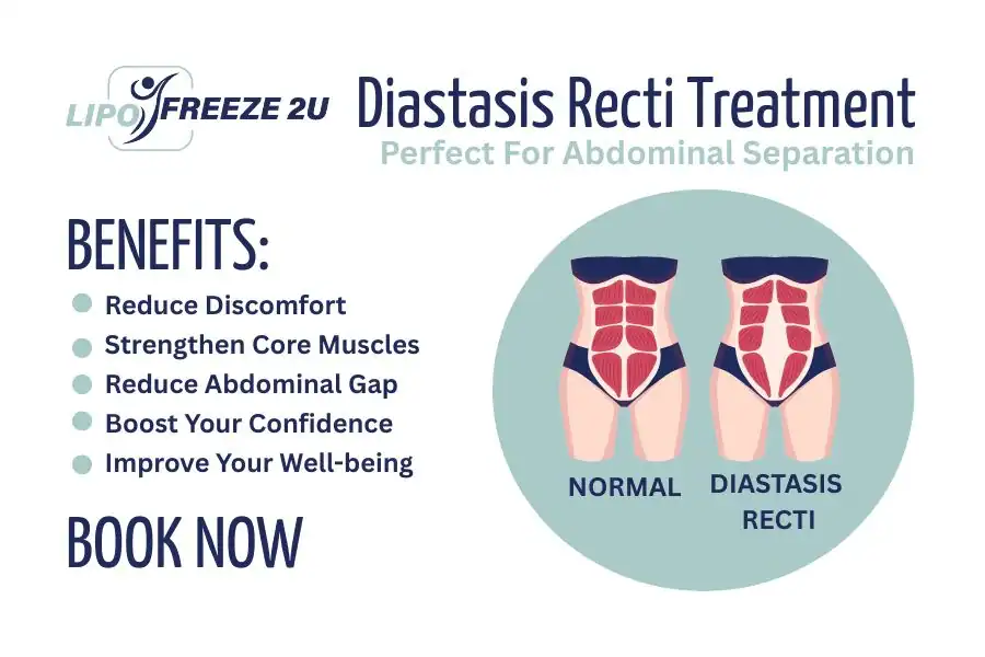 How Long Will It Take to See Improvements in Diastasis Recti Bletchley