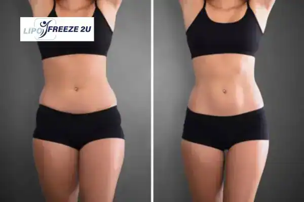 How Can LIPO FREEZE 2U Support Your Post-Pregnancy Body Recovery Bletchley?
