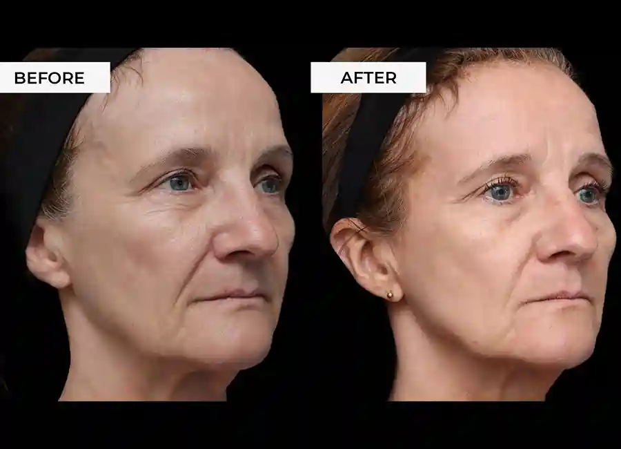 How Many RF Microneedling Sessions Will You Need to See a Difference Bletchley?