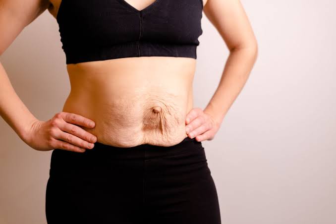 Is Surgery Really the Only Way to Repair Diastasis Recti Bletchley?
