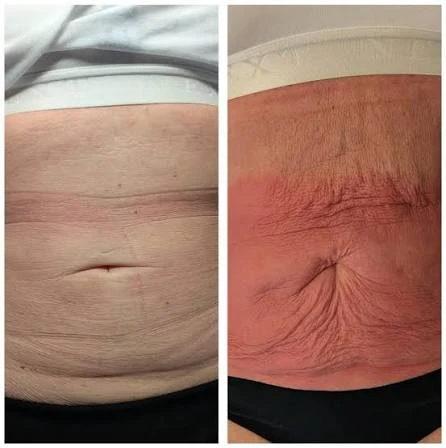 How Does RF Microneedling Improve Crepey, Thin and Uneven Skin Texture Bletchley?