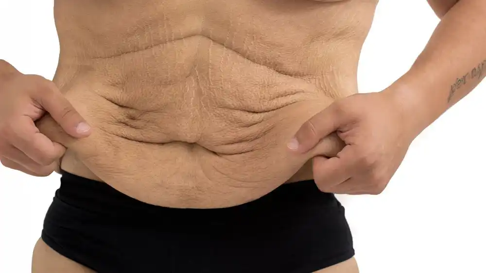 RF Microneedling for Loose Skin: How Can It Help Tighten and Reshape the Skin Bletchley?